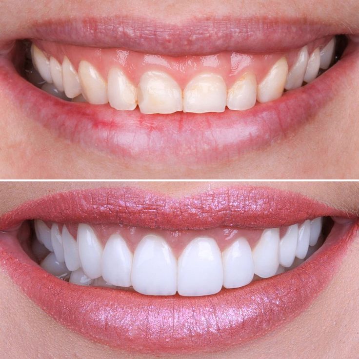 smile makeover cosmetic dentistry